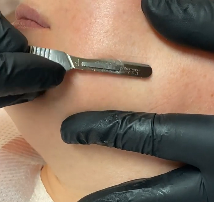 dermaplaning
