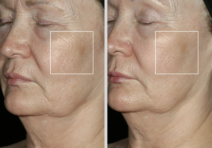 Elastiderm FACIAL Serum - Obagi Medical